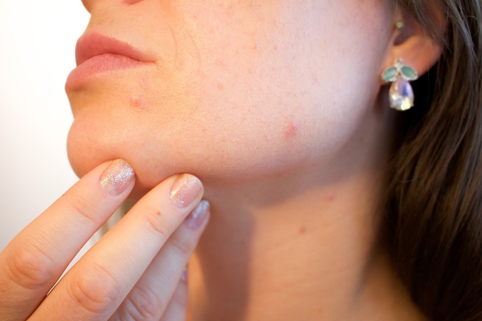 4 Dermatologische methoden voor littekenverwijdering