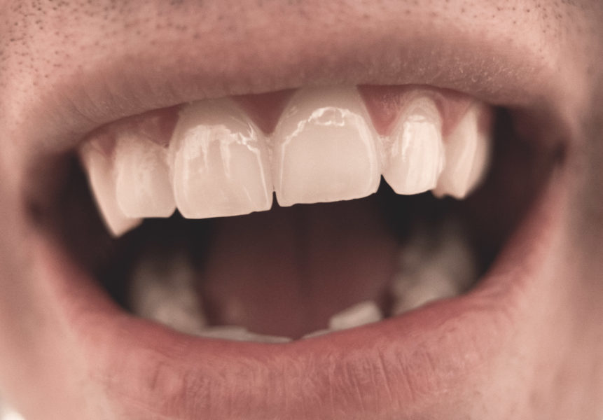 Tanden bonding en glazuurvorming voor een verbeterde glimlach